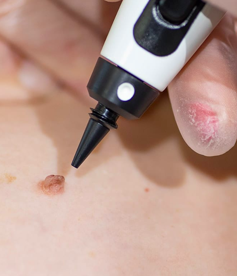 skin tag removal